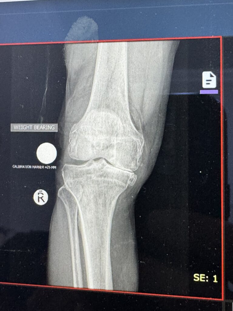Right knee bone on bone